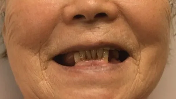 Case 01 — Real Patient Smile Transformation before treatment