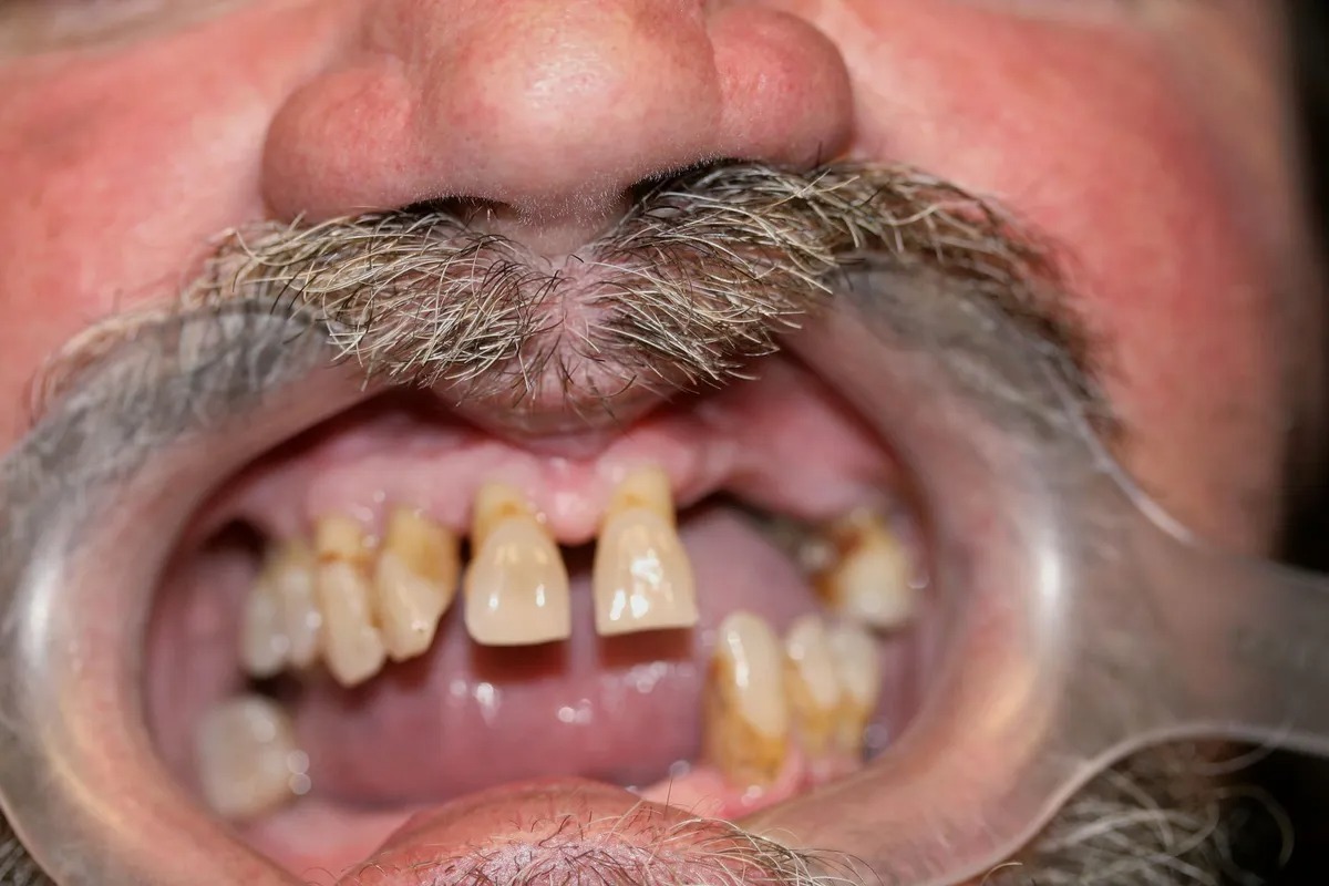 Case 01 — Real Patient Smile Transformation before treatment