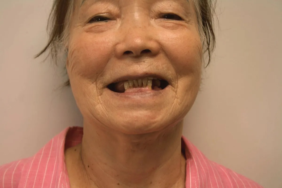 Case 02 — Real Patient Smile Transformation before treatment