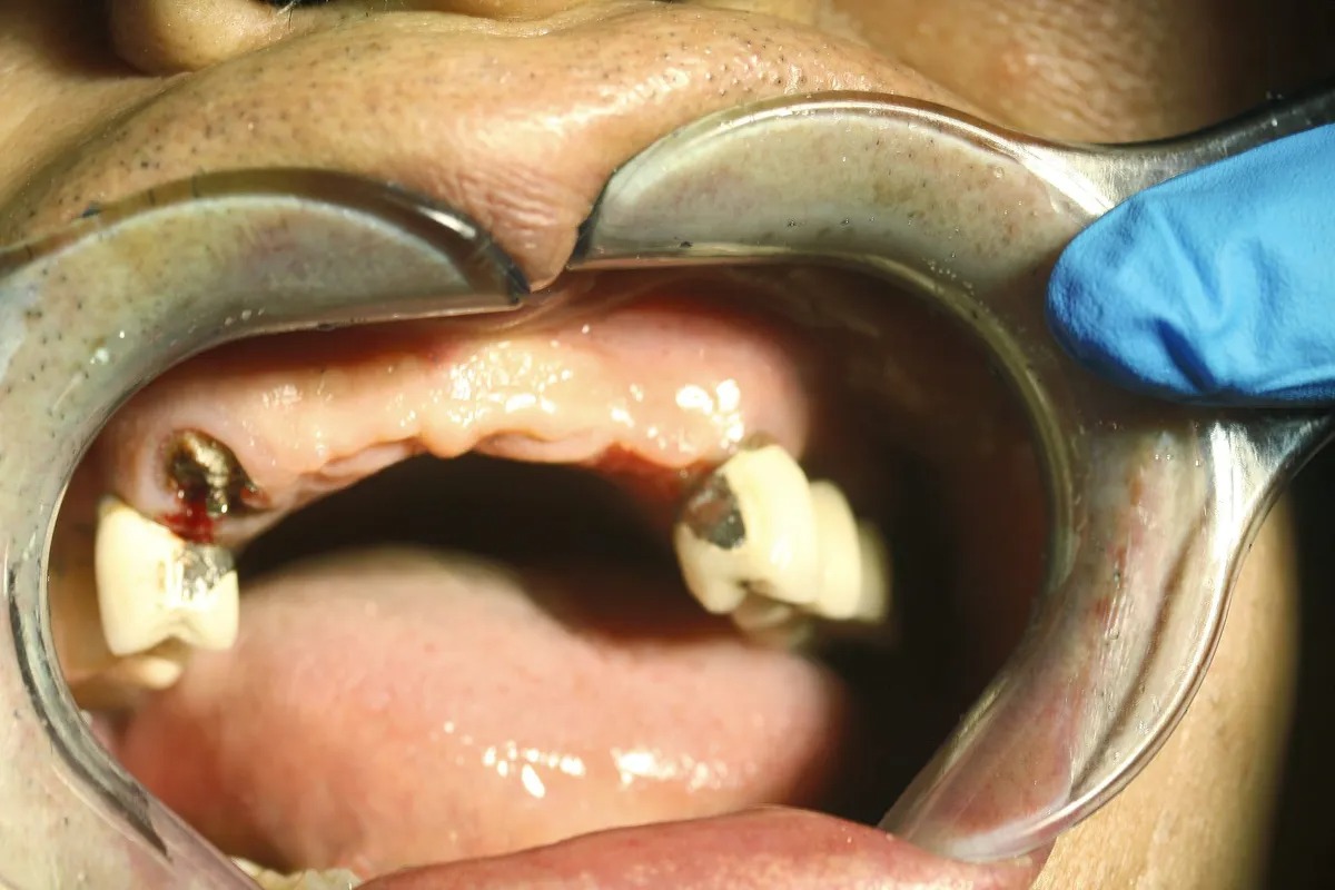 Case 03 — Real Patient Smile Transformation before treatment