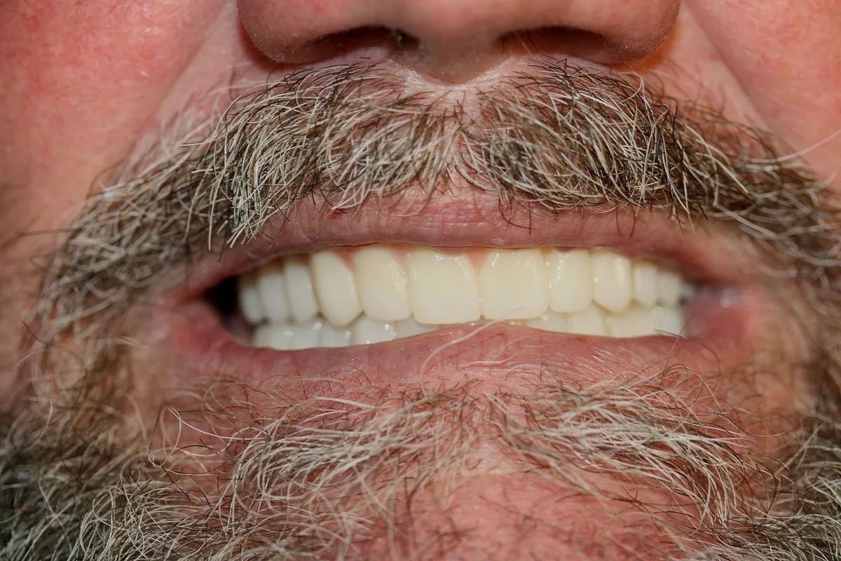 Case 01 — Real Patient Smile Transformation after treatment