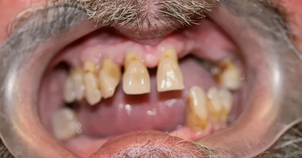 Case 02 — Real Patient Smile Transformation before treatment