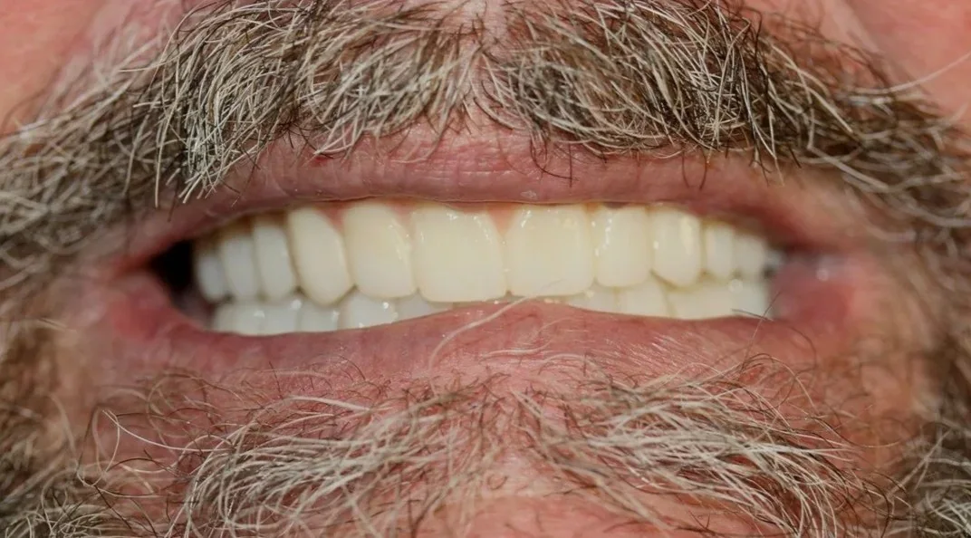 Case 02 — Real Patient Smile Transformation after treatment